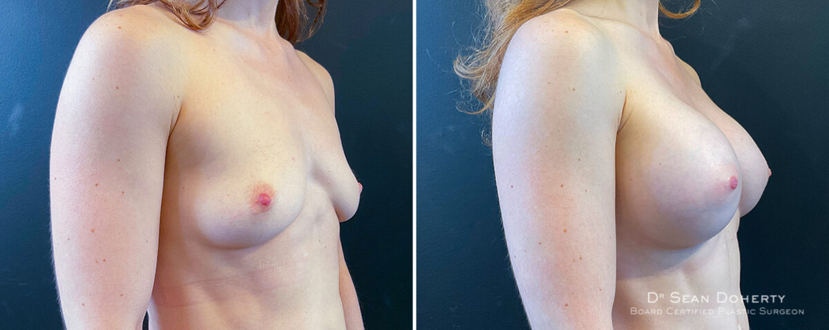 Breast Augmentation Before and After Photos in Boston, MA, Patient 16505