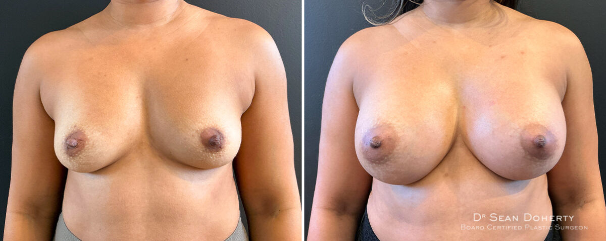 Breast Augmentation Before and After Photos in Boston, MA, Patient 16515