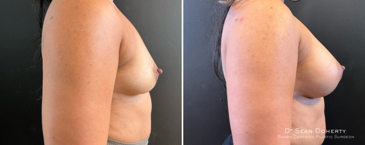 Breast Augmentation Before and After Photos in Boston, MA, Patient 16515