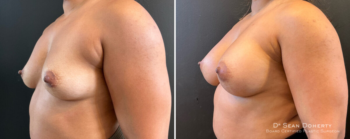 Breast Augmentation Before and After Photos in Boston, MA, Patient 16515