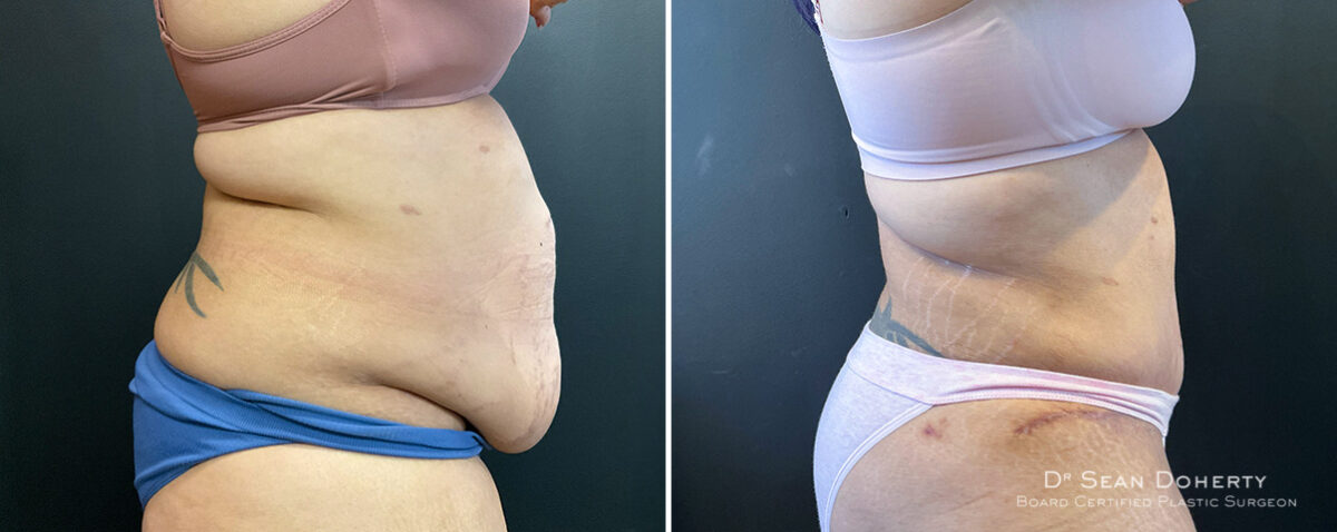 Liposuction Before and After Photos in Boston, MA, Patient 16567