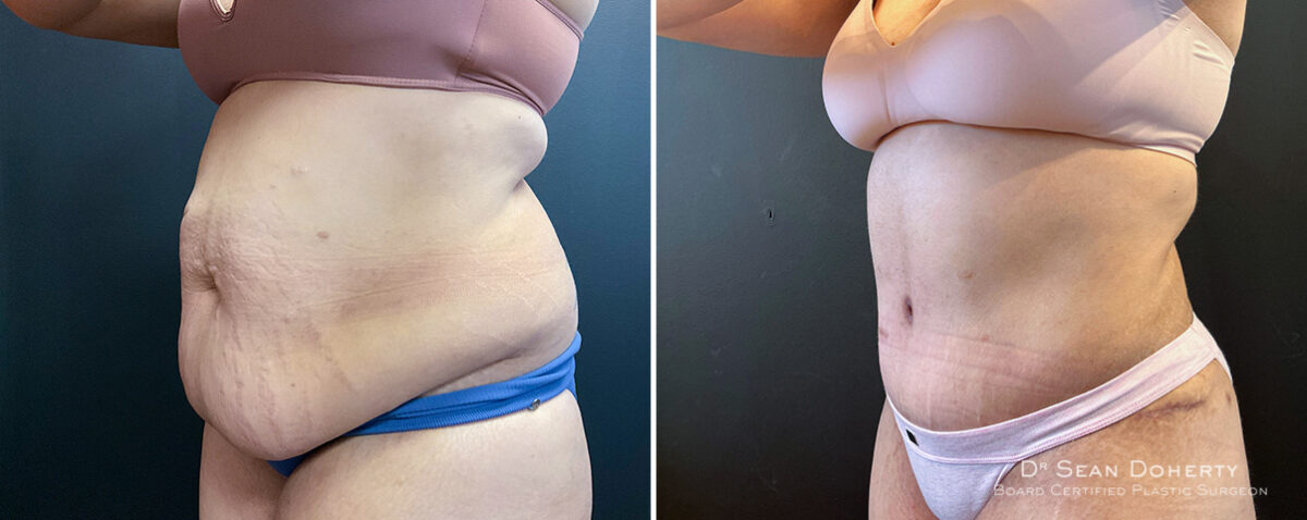 Liposuction Before and After Photos in Boston, MA, Patient 16567