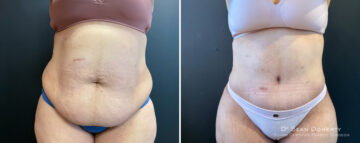 Liposuction Before and After Photos in Boston, MA, Patient 16567