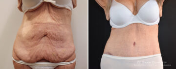 Tummy Tuck Before and After Photos in Boston, MA, Patient 16577