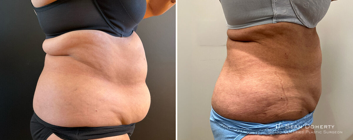 Liposuction Before and After Photos in Boston, MA, Patient 16615