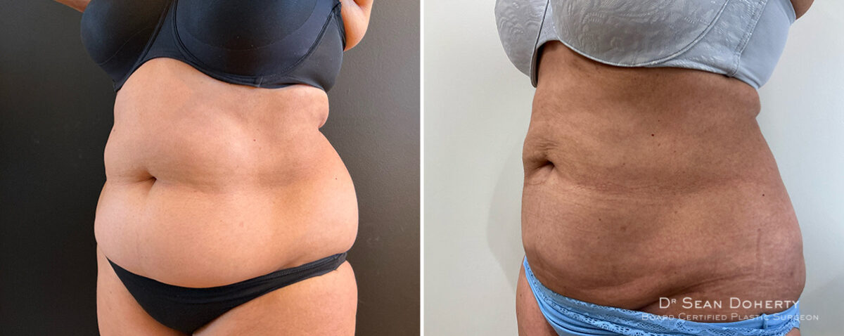 Liposuction Before and After Photos in Boston, MA, Patient 16615