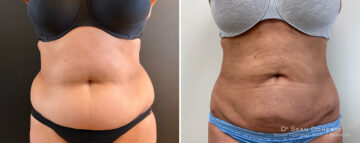 Liposuction Before and After Photos in Boston, MA, Patient 16615