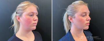 Liposuction Before and After Photos in Boston, MA, Patient 16625