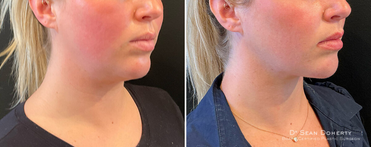 Liposuction Before and After Photos in Boston, MA, Patient 16625