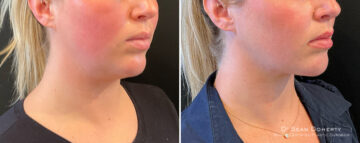 Liposuction Before and After Photos in Boston, MA, Patient 16625