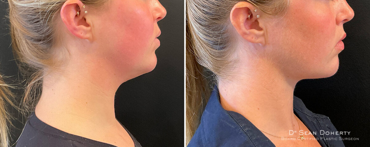 Liposuction Before and After Photos in Boston, MA, Patient 16625