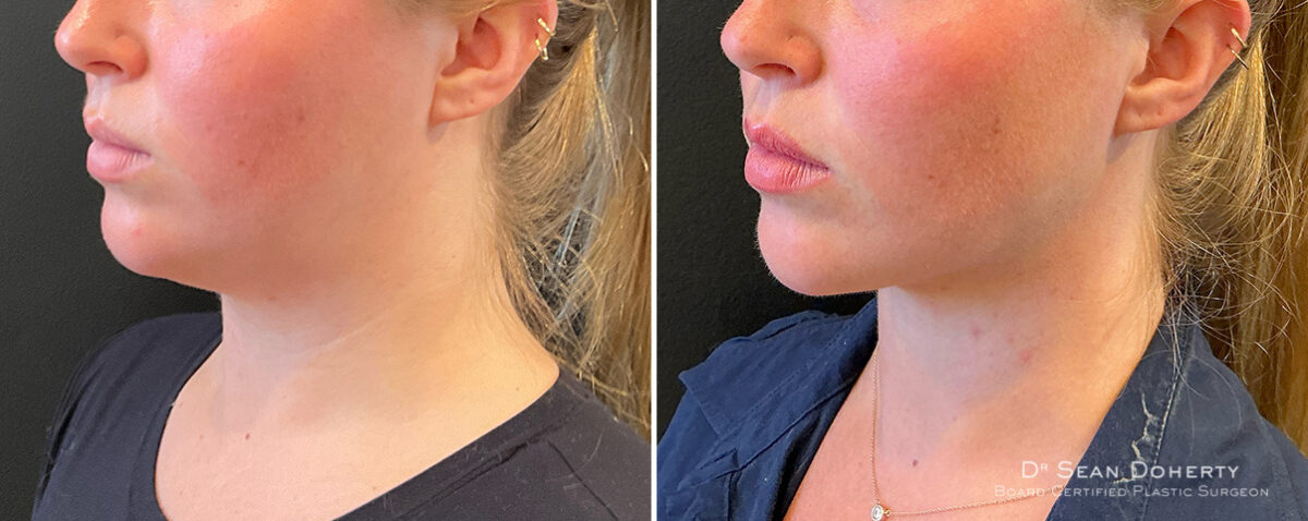 Liposuction Before and After Photos in Boston, MA, Patient 16625