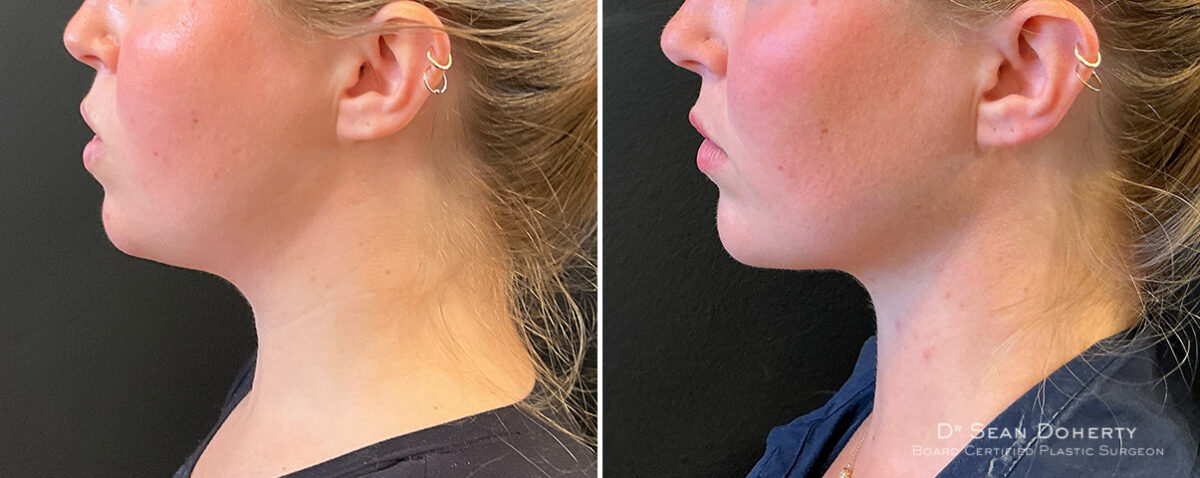 Liposuction Before and After Photos in Boston, MA, Patient 16625