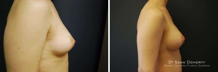 Breast Implant Exchange Before and After Photos in Boston, MA, Patient 2421