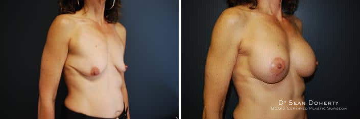Breast Lift with Implants Before and After Photos in Boston, MA, Patient 2445