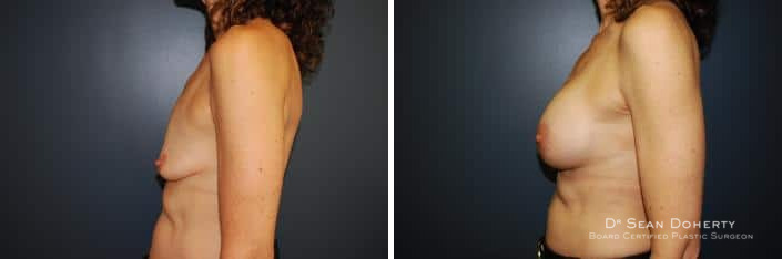 Breast Lift with Implants Before and After Photos in Boston, MA, Patient 2445