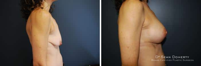 Breast Lift with Implants Before and After Photos in Boston, MA, Patient 2445