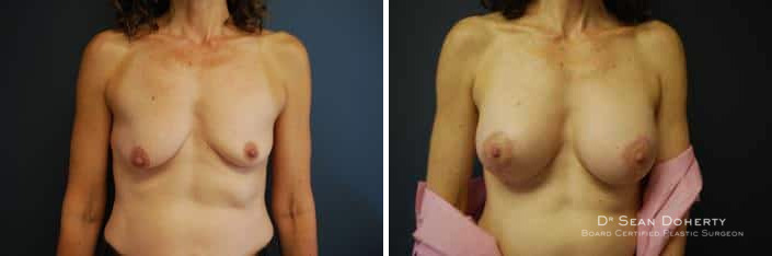 Breast Lift with Implants Before and After Photos in Boston, MA, Patient 2445
