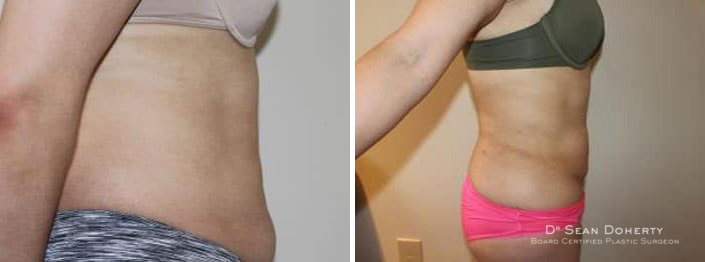 Liposuction Before and After Photos in Boston, MA, Patient 2462