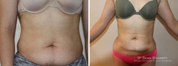 Liposuction Before and After Photos in Boston, MA, Patient 2462