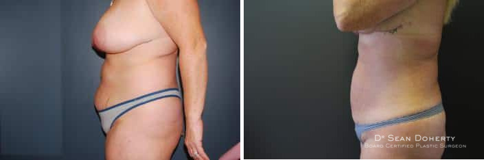 Liposuction Before and After Photos in Boston, MA, Patient 2476