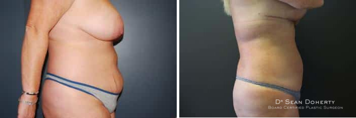 Liposuction Before and After Photos in Boston, MA, Patient 2476