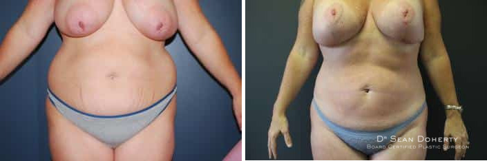 Liposuction Before and After Photos in Boston, MA, Patient 2476