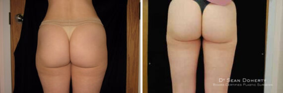 Liposuction Before and After Photos in Boston, MA, Patient 2486