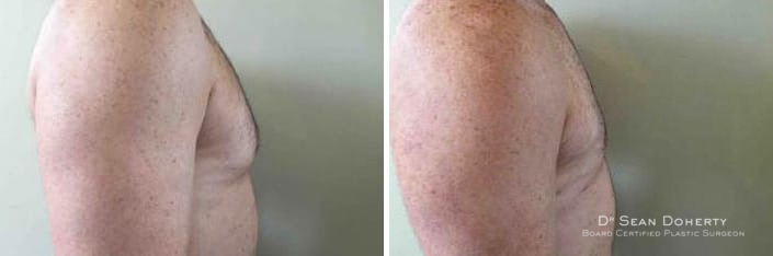 Gynecomastia Before and After Photos in Boston, MA, Patient 2533