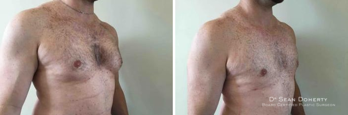 Gynecomastia Before and After Photos in Boston, MA, Patient 2533
