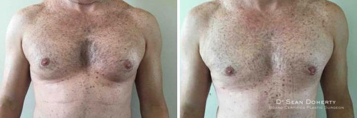 Gynecomastia Before and After Photos in Boston, MA, Patient 2533