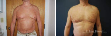 Liposuction Before and After Photos in Boston, MA, Patient 2551