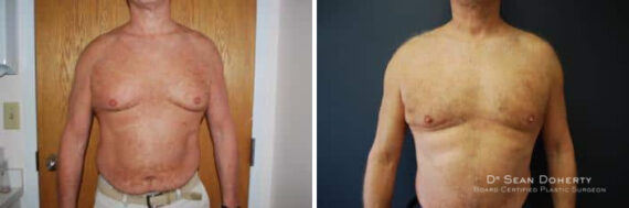 Liposuction Before and After Photos in Boston, MA, Patient 2551