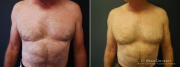 Liposuction Before and After Photos in Boston, MA, Patient 2562