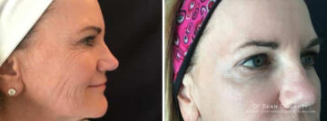 Botox Before and After Photos in Boston, MA, Patient 2576