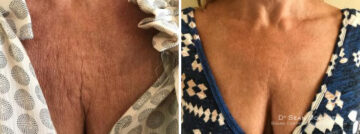 Botox Before and After Photos in Boston, MA, Patient 2579