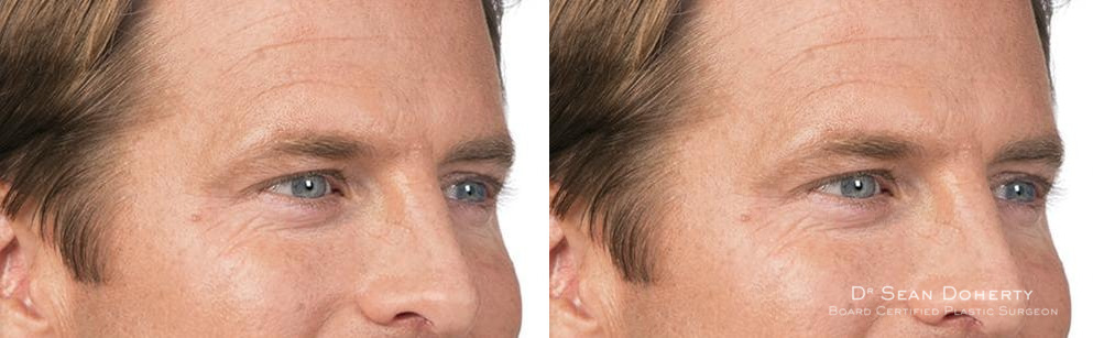Botox Before and After Photos in Boston, MA, Patient 2582