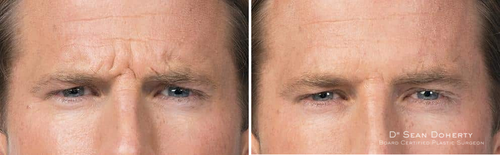 Botox Before and After Photos in Boston, MA, Patient 2582