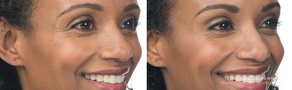Botox Before and After Photos in Boston, MA, Patient 2587