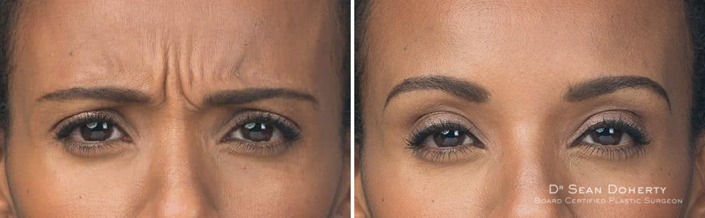 Botox Before and After Photos in Boston, MA, Patient 2587