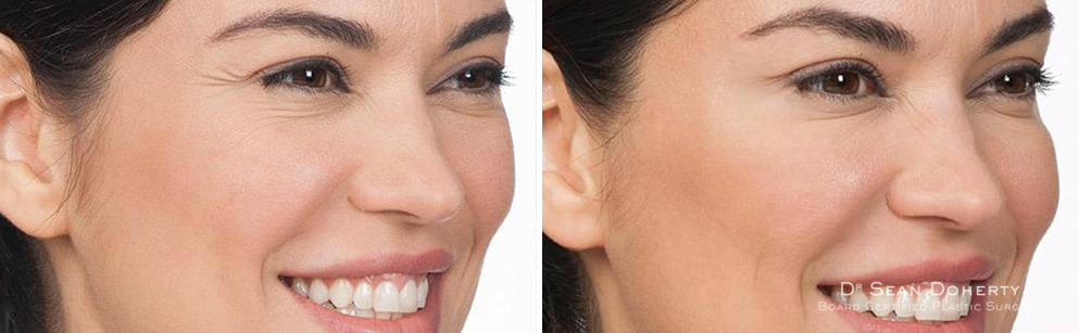 Botox Before and After Photos in Boston, MA, Patient 2592