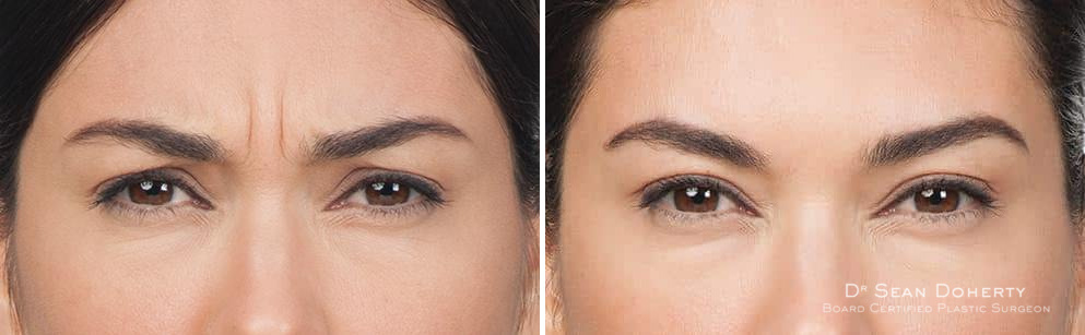 Botox Before and After Photos in Boston, MA, Patient 2592