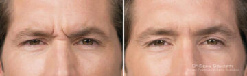 Botox Before and After Photos in Boston, MA, Patient 2597