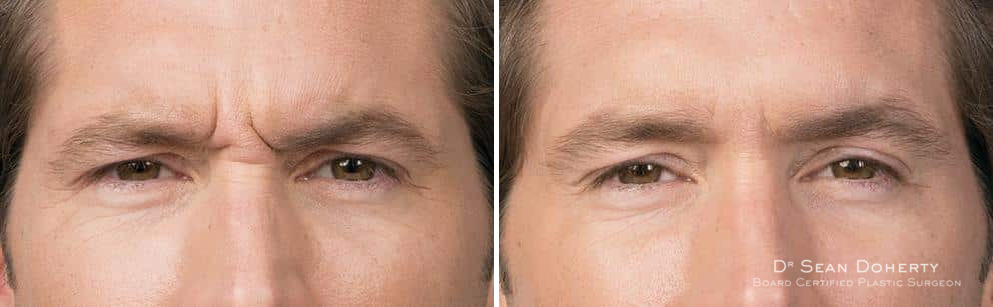 Botox Before and After Photos in Boston, MA, Patient 2597