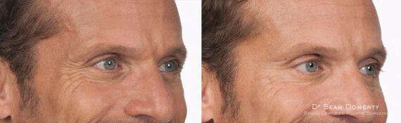 Botox Before and After Photos in Boston, MA, Patient 2612