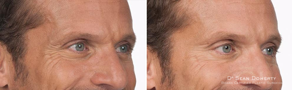 Botox Before and After Photos in Boston, MA, Patient 2612