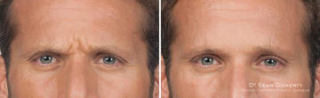 Botox Before and After Photos in Boston, MA, Patient 2612