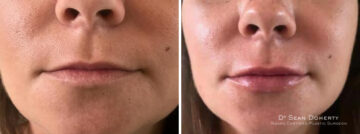 Lip Augmentation Before and After Photos in Boston, MA, Patient 2622