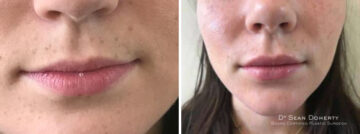 Lip Augmentation Before and After Photos in Boston, MA, Patient 2625