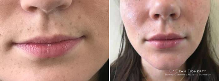 Lip Augmentation Before and After Photos in Boston, MA, Patient 2625